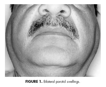 Sialosis / Sialadenosis6